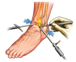 Arthroscopy-Ankle